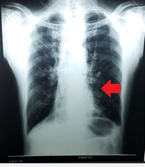 mild cardiomegaly.